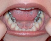 Amalgum Fillings.jpg